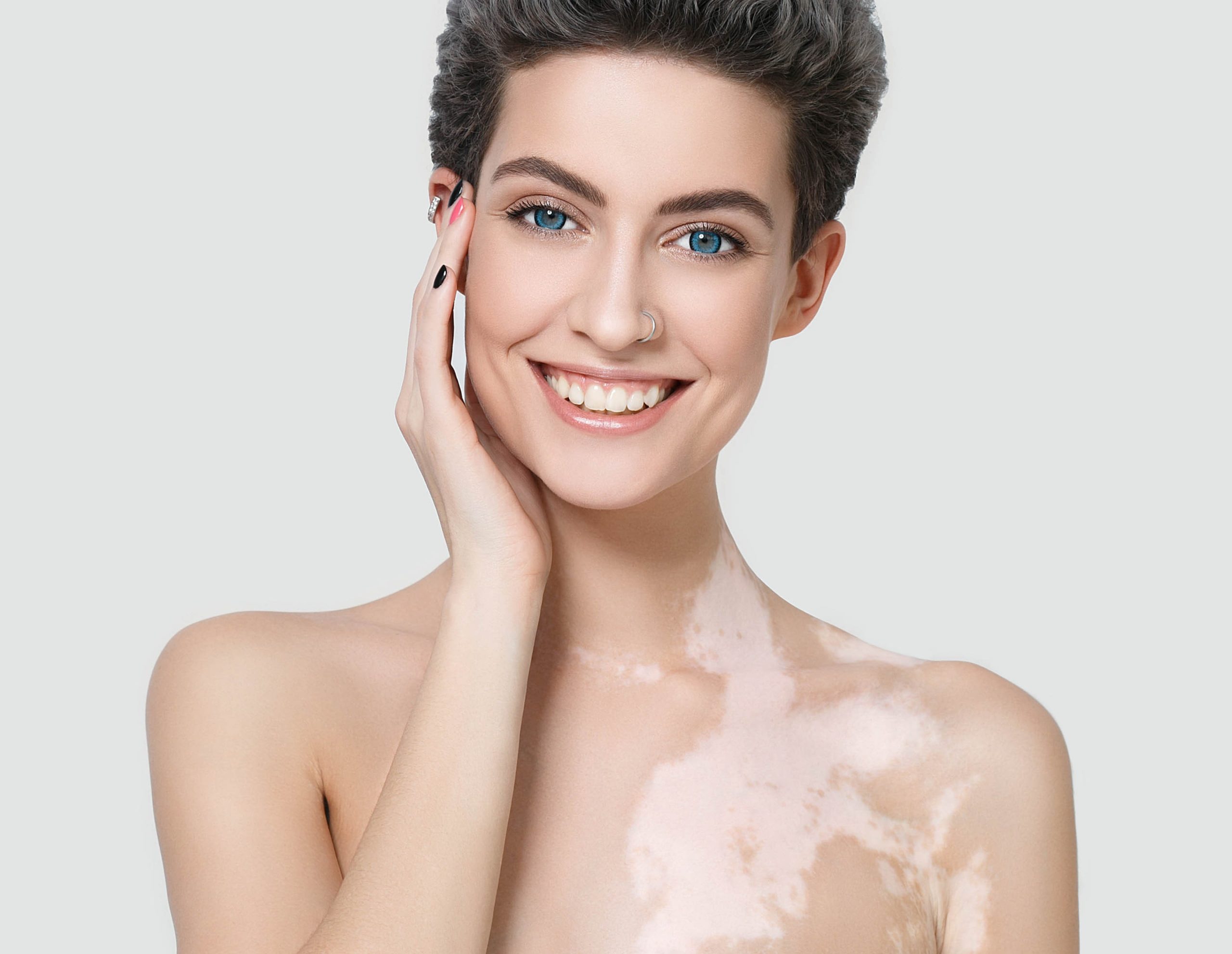 Vitiligo İçin 2 Kolay Bitkisel Tedavi