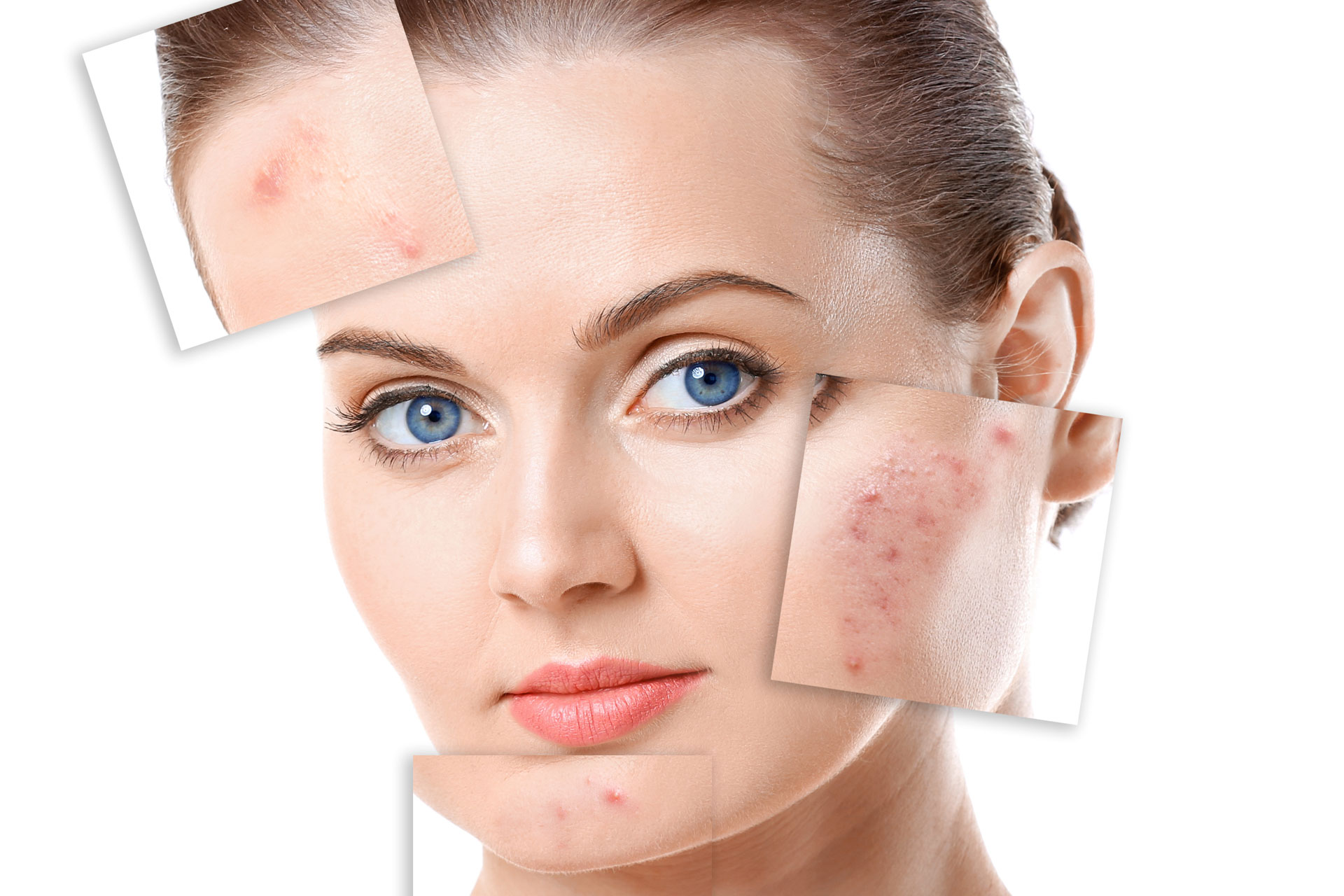 Sivilcelere Karşı Etkili Denenmiş Maske Tarifi