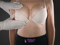 Göğüs Küçültme Ameliyatları